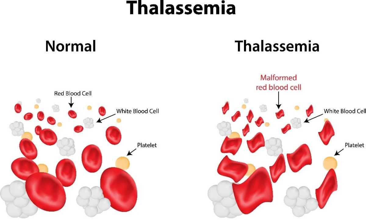 Thalassemia (FAQ) 2